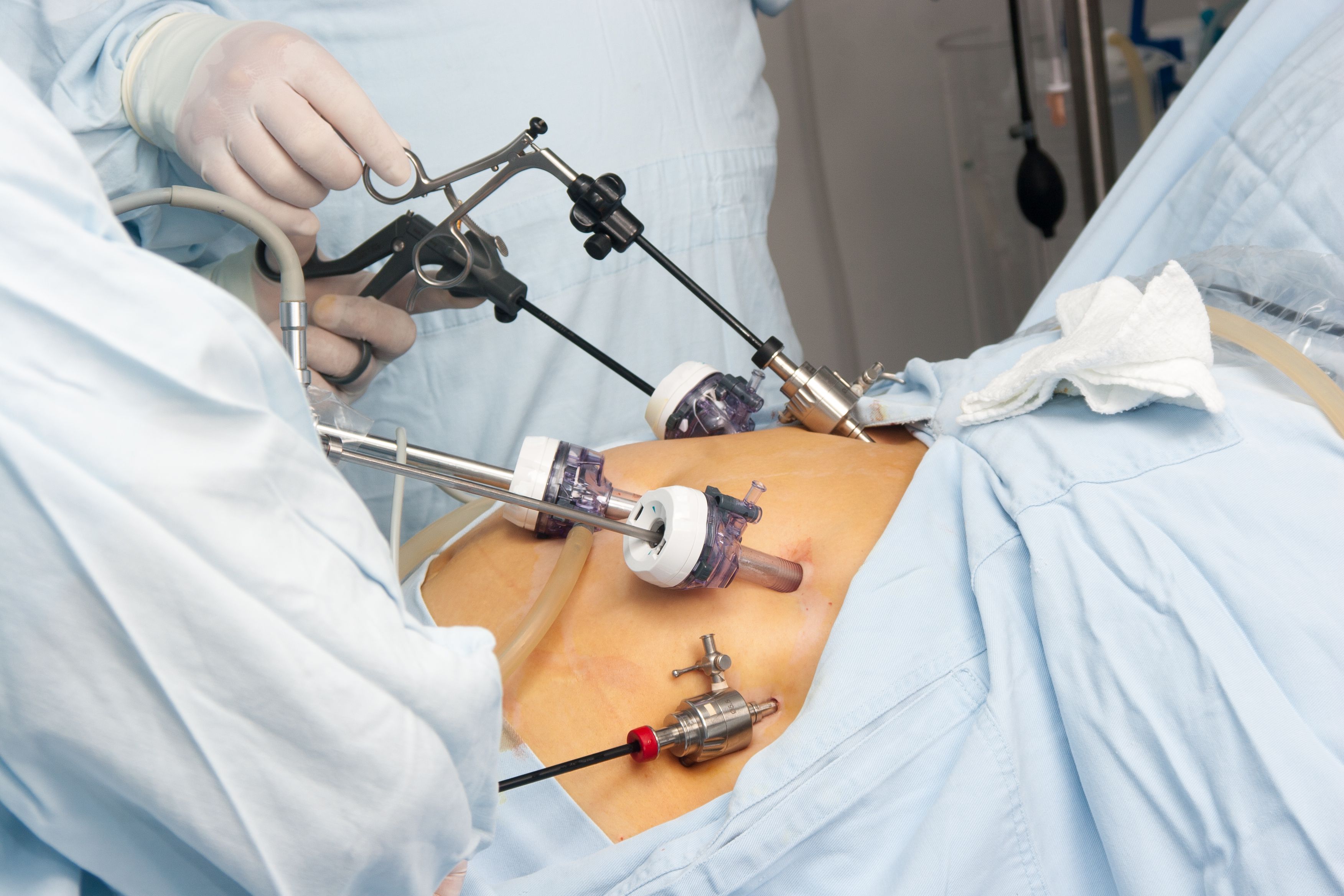 WEIGHT LOSS BARIATRIC LAPROSCOPIC SURGERY