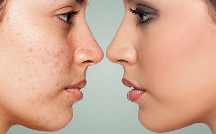 ACNE & ACNE SCARS TREATMENT