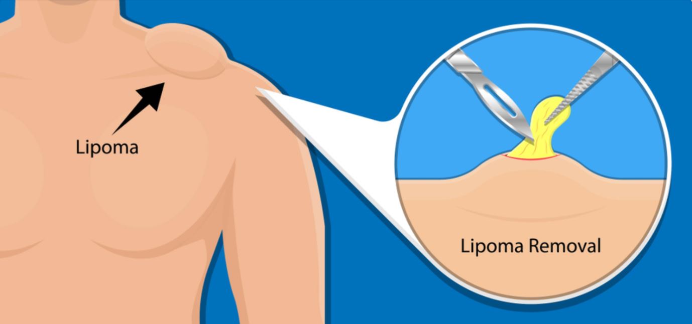 LIPOMA EXCLSION